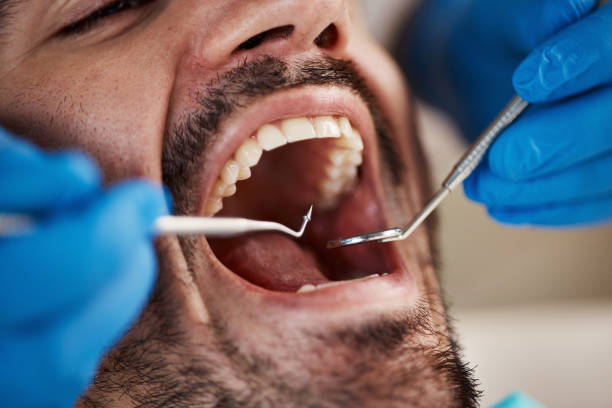 Best Emergency Wisdom Teeth Removal in Lemmon, SD