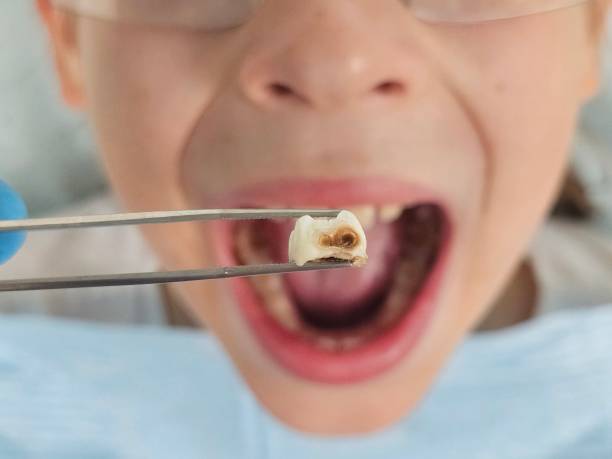 Best Emergency Dental Care for Broken or Chipped Teeth in Lemmon, SD